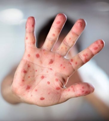 Measles: The Forgotten Virus is Making a Comeback