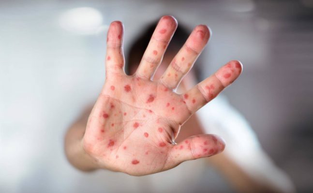 Measles: The Forgotten Virus is Making a Comeback (Viewing Only)