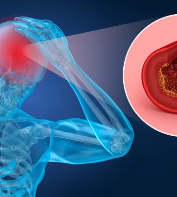 Long Term Anticoagulation in Stroke Prevention