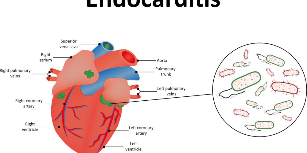 EndocarditisPic (1)