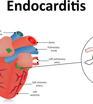 Endocarditis: Prevention and Treatment