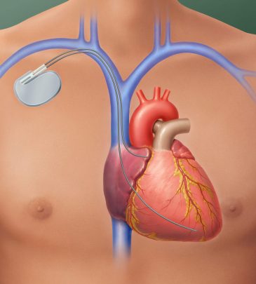 Understanding the Role of Surgical Interventions in Cardiac Arrythmias