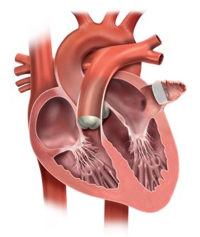 diagram of A-fib and stroke in heart